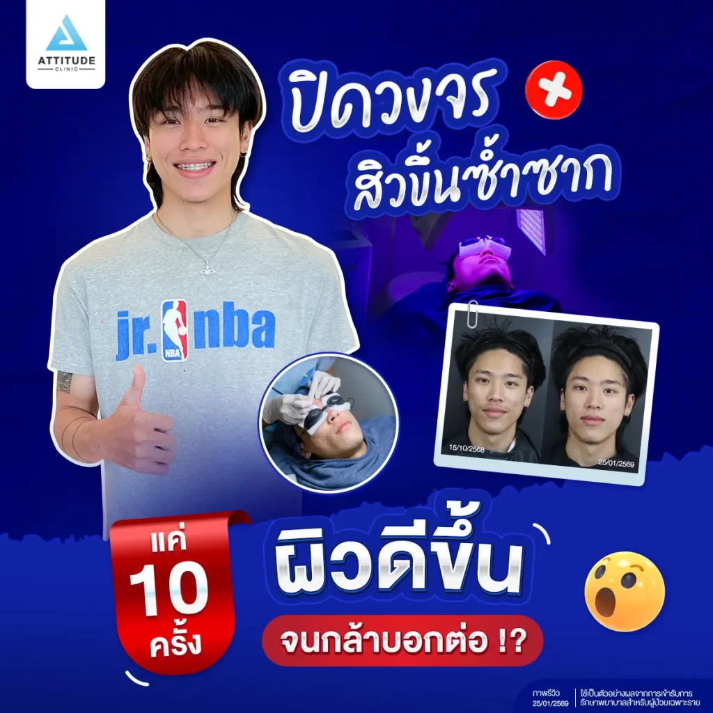 ทำคอร์สเดียว แต่สิวหายจนอยากบอกต่อ! โปรแกรม Light Clear ที่พี่เต็งหนึ่งแนะนำ ดีจริงไหม? ตามมาดูผลลัพธ์กันเลย