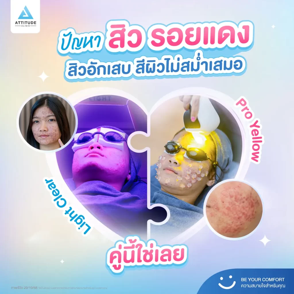 วาเลนไทน์นี้อยากหน้าเนียนใส สิวไม่กวนใจก่อนออกเดท มาหา “คู่ที่ใช่” รักษาสิว รอยสิวกัน