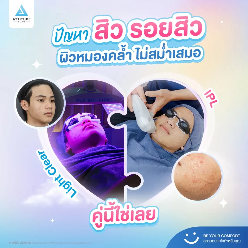 วาเลนไทน์นี้อยากหน้าเนียนใส สิวไม่กวนใจก่อนออกเดท มาหา “คู่ที่ใช่” รักษาสิว รอยสิวกัน