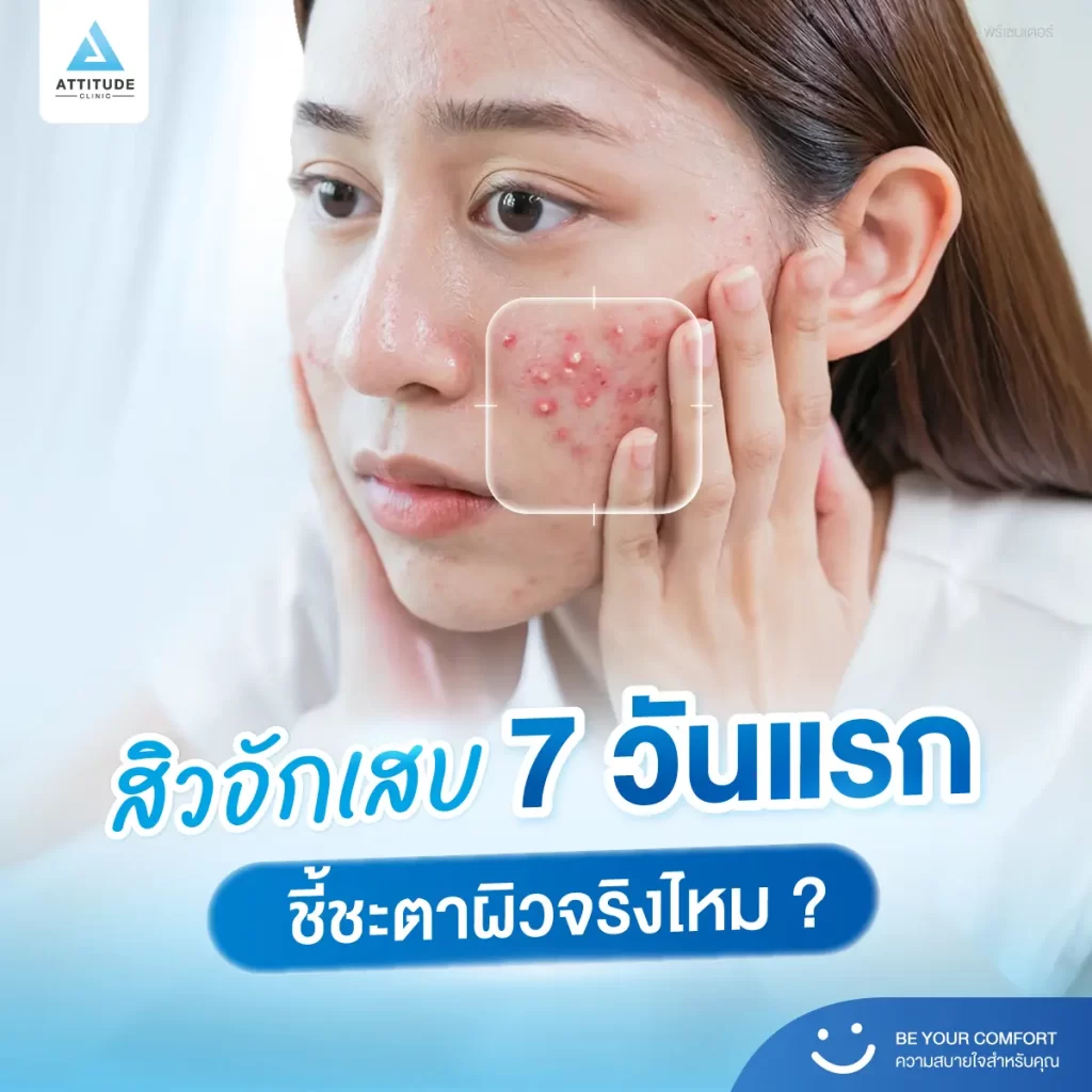 สิวอักเสบ 7 วันแรก ชี้ชะตาอนาคตผิวได้จริงไหม !? คำถามนี้ งานวิจัยมีคำตอบให้ครับ