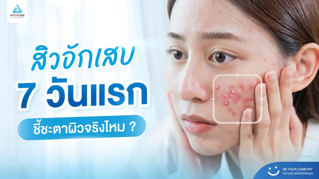 สิวอักเสบ 7 วันแรก ชี้ชะตาอนาคตผิวได้จริงไหม !? คำถามนี้ งานวิจัยมีคำตอบให้ครับ