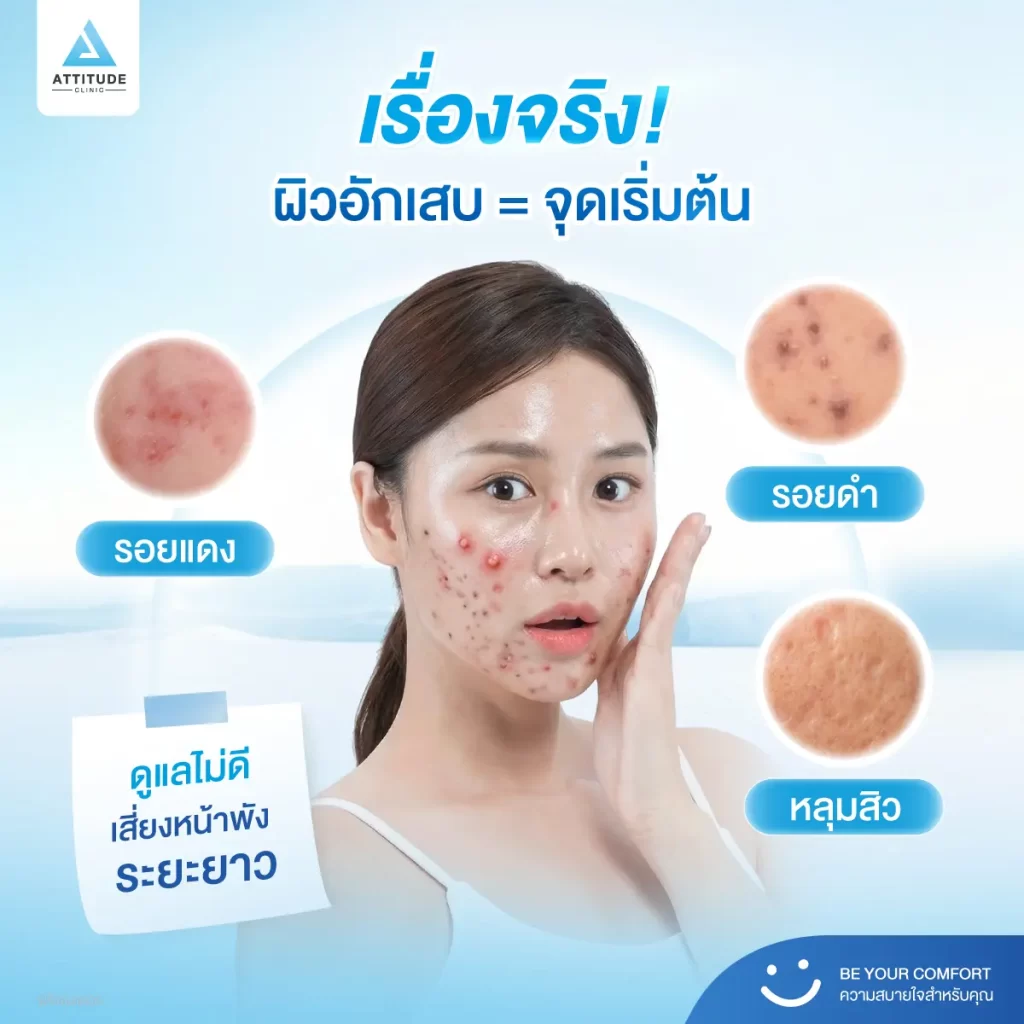 สิวอักเสบ 7 วันแรก ชี้ชะตาอนาคตผิวได้จริงไหม !? คำถามนี้ งานวิจัยมีคำตอบให้ครับ