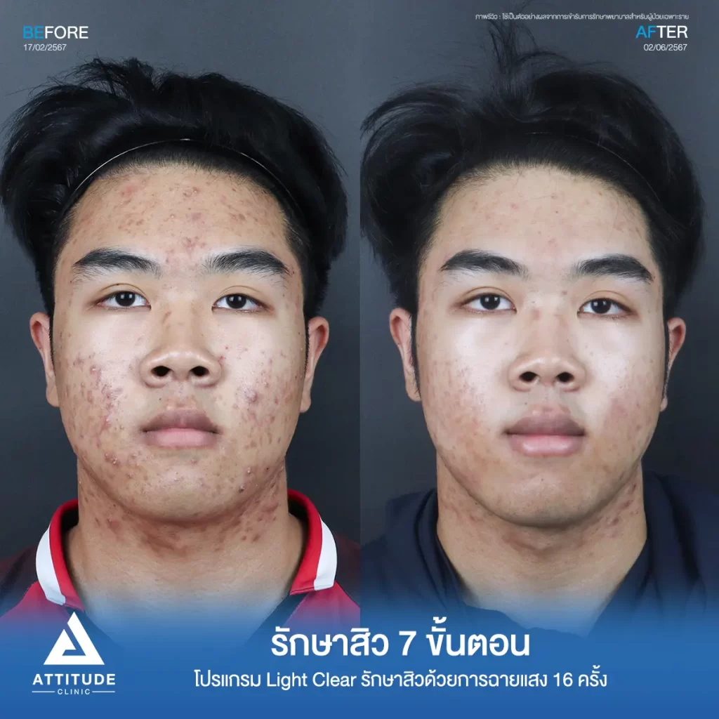 รีวิวรักษาสิวพี่พี โปรแกรม Light Clear รักษาสิวด้วยการฉายแสง จำนวน 16 ครั้งที่ Attitude Clinic