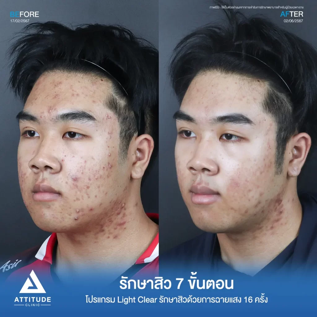 รีวิวรักษาสิวพี่พี โปรแกรม Light Clear รักษาสิวด้วยการฉายแสง จำนวน 16 ครั้งที่ Attitude Clinic
