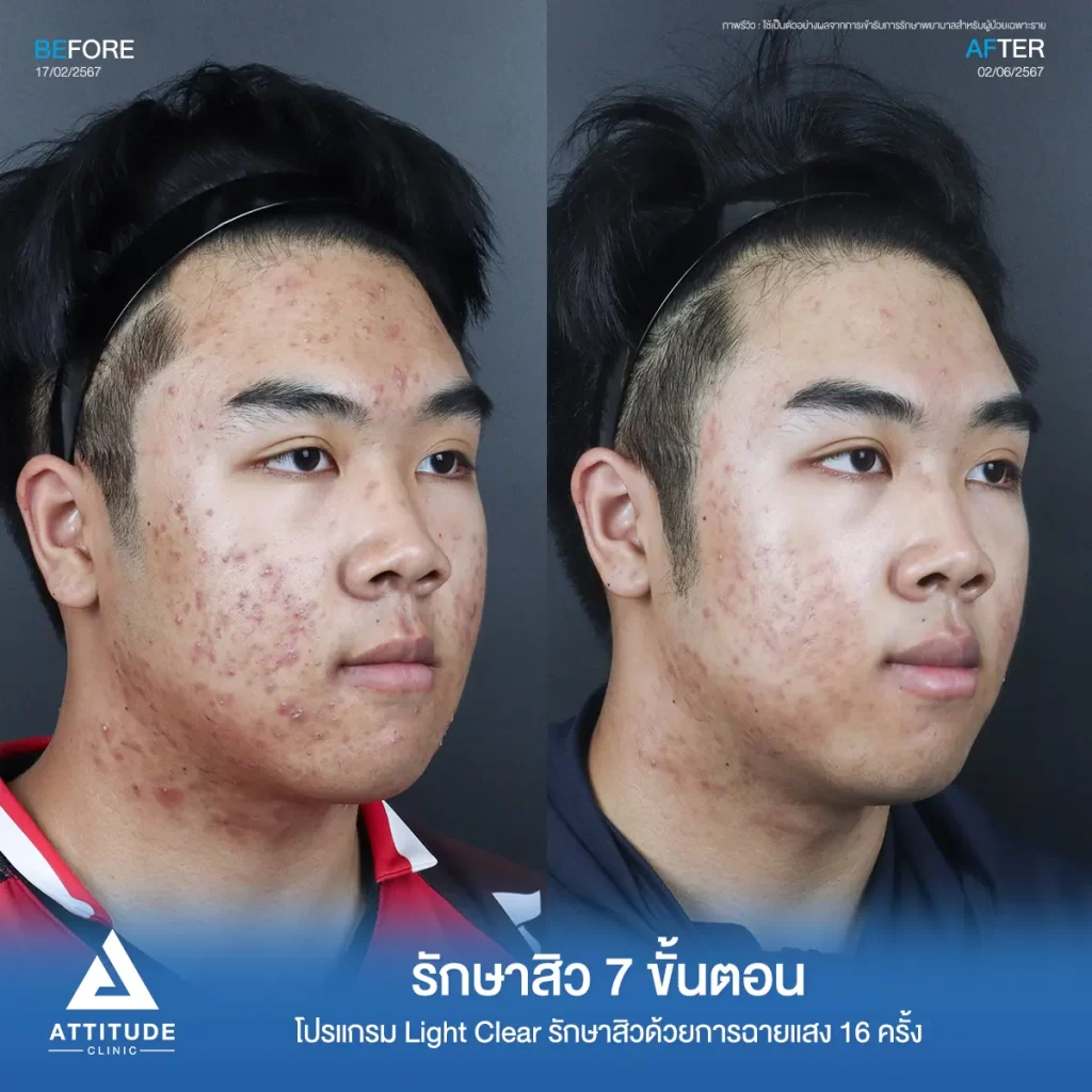 รีวิวรักษาสิวพี่พี โปรแกรม Light Clear รักษาสิวด้วยการฉายแสง จำนวน 16 ครั้งที่ Attitude Clinic