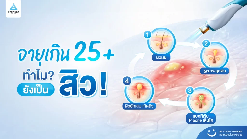 อายุ 25+ ทำไมยังเป็นสิวไม่เลิก ?!