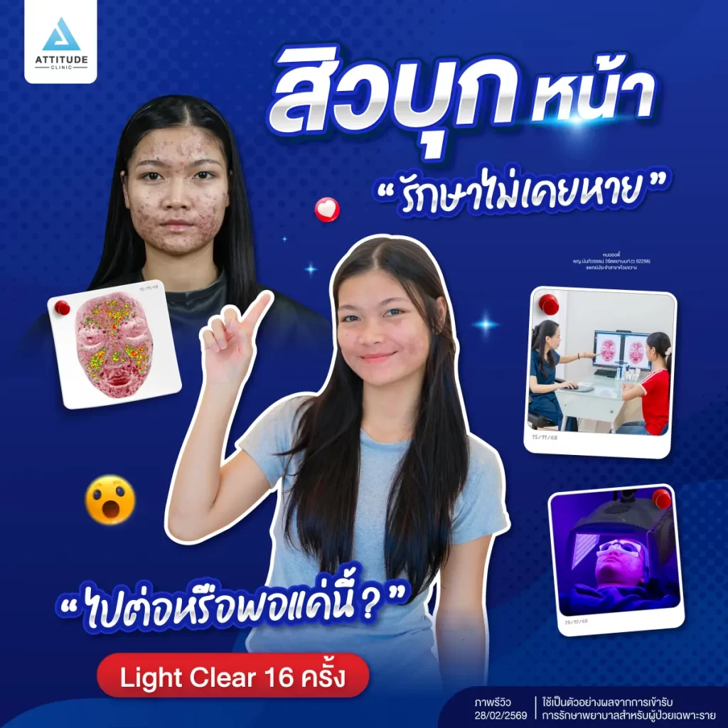 สิวบุกลามทั่วหน้า รักษายังไงก็ไม่หาย !? ตัดสินใจรักษาสิวที่ ATTITUDE CLINIC เคสนี้จะได้ไปต่อหรือพอแค่นี้