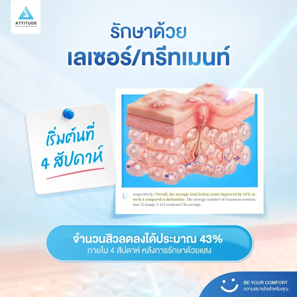 รักษาสิวกี่ครั้งหาย ? กี่ครั้งจบ ? งานวิจัยมีคำตอบ