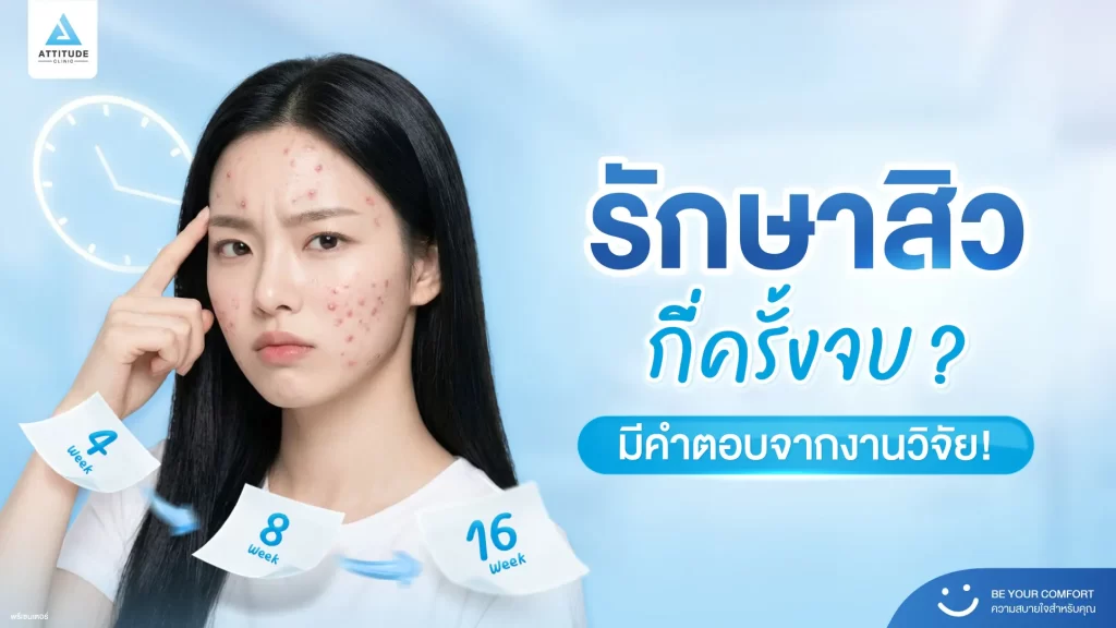 รักษาสิวกี่ครั้งหาย ? กี่ครั้งจบ ? งานวิจัยมีคำตอบ