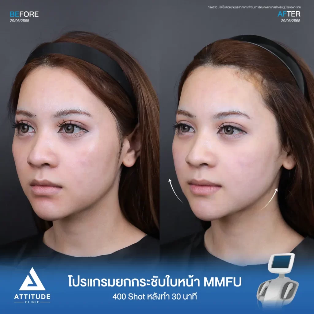 รีวิวโปรแกรมยกกระชับ Ultraformer III ของพี่บัว จำนวน 400 shot หลังทำ 30 นาที ยกกระชับปรับรูปหน้า จัดการแก้มห้อยย้อยที่ ATTITUDE CLINIC