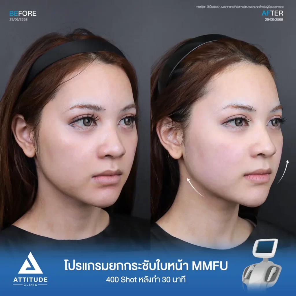 รีวิวโปรแกรมยกกระชับ Ultraformer III ของพี่บัว จำนวน 400 shot หลังทำ 30 นาที ยกกระชับปรับรูปหน้า จัดการแก้มห้อยย้อยที่ ATTITUDE CLINIC