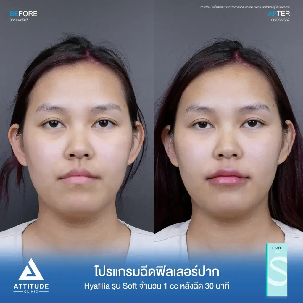 รีวิวโปรแกรมฉีดฟิลเลอร์ปากพี่ธณัฐชา Hya รุ่น S จำนวน 1 cc หลังทำ 30 นาที แก้ทรงปาก เติมเต็มให้ริมฝีปากอิ่มฟูขึ้นที่ ATTITUDE CLINIC