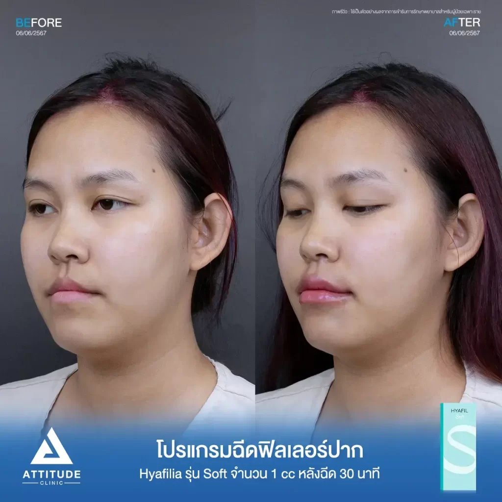 รีวิวโปรแกรมฉีดฟิลเลอร์ปากพี่ธณัฐชา Hya รุ่น S จำนวน 1 cc หลังทำ 30 นาที แก้ทรงปาก เติมเต็มให้ริมฝีปากอิ่มฟูขึ้นที่ ATTITUDE CLINIC