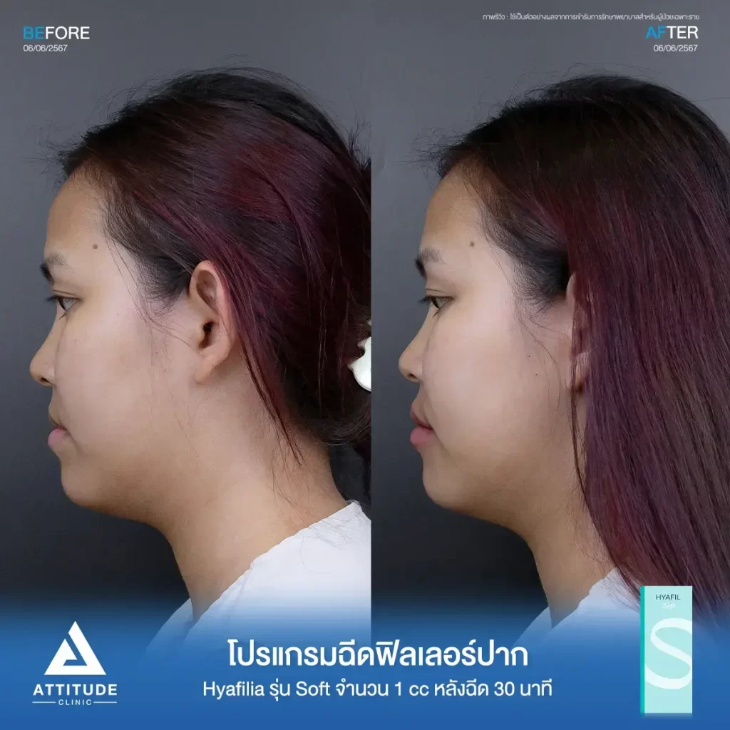 รีวิวโปรแกรมฉีดฟิลเลอร์ปากพี่ธณัฐชา Hya รุ่น S จำนวน 1 cc หลังทำ 30 นาที แก้ทรงปาก เติมเต็มให้ริมฝีปากอิ่มฟูขึ้นที่ ATTITUDE CLINIC