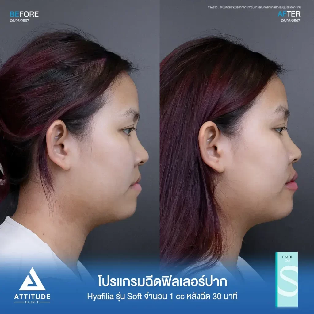 รีวิวโปรแกรมฉีดฟิลเลอร์ปากพี่ธณัฐชา Hya รุ่น S จำนวน 1 cc หลังทำ 30 นาที แก้ทรงปาก เติมเต็มให้ริมฝีปากอิ่มฟูขึ้นที่ ATTITUDE CLINIC