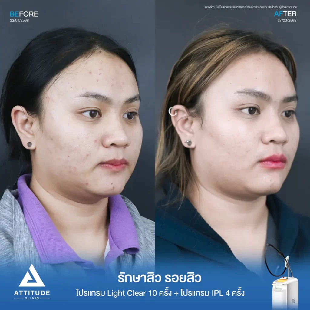 รีวิวรักษาสิวพี่แป้ง โปรแกรม Light Clear รักษาสิวด้วยการฉายแสง จำนวน 10 ครั้ง ต่อด้วยโปรแกรม IPL รักษารอยสิว จำนวน 4 ครั้งที่ Attitude Clinic