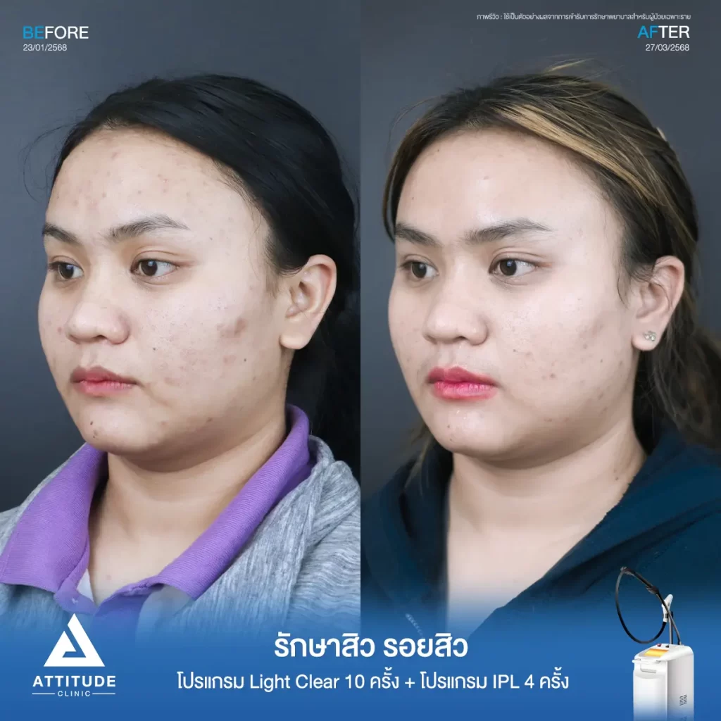 รีวิวรักษาสิวพี่แป้ง โปรแกรม Light Clear รักษาสิวด้วยการฉายแสง จำนวน 10 ครั้ง ต่อด้วยโปรแกรม IPL รักษารอยสิว จำนวน 4 ครั้งที่ Attitude Clinic