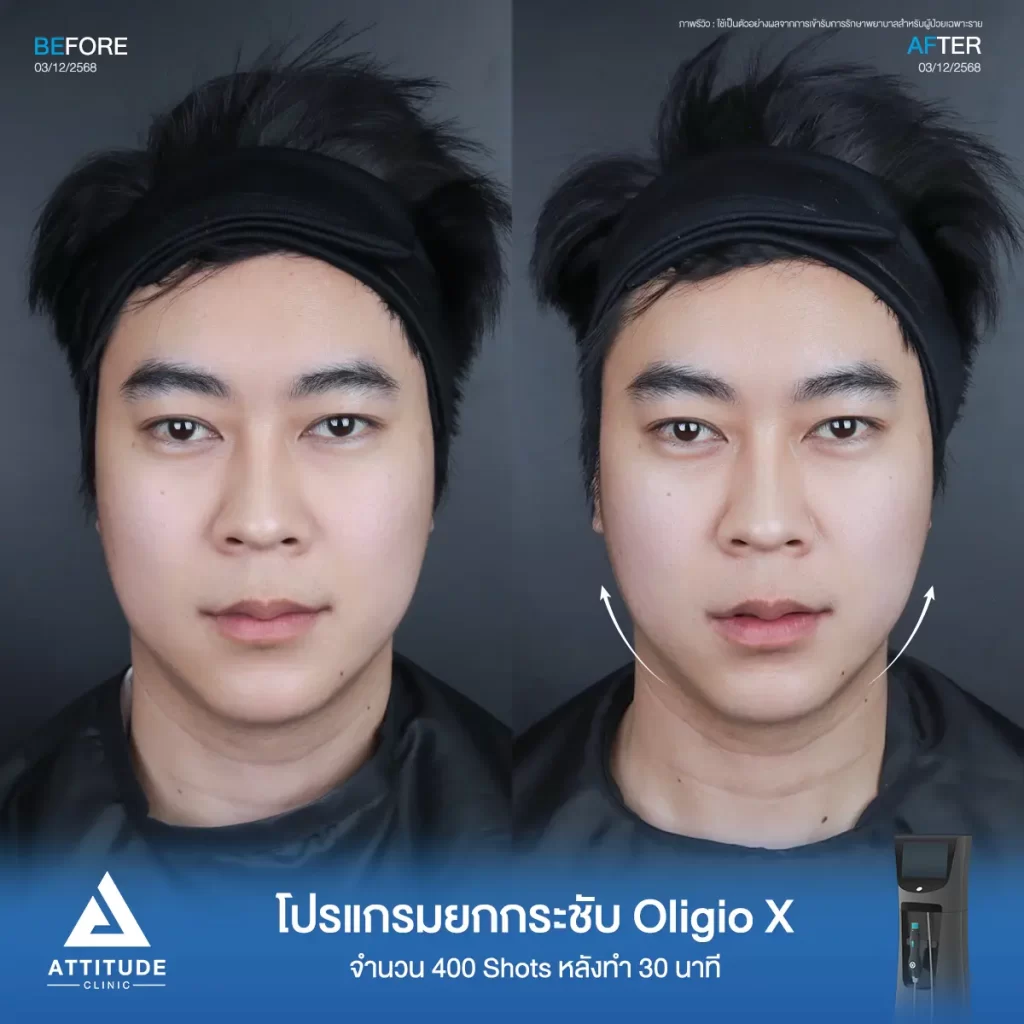 รีวิวโปรแกรมยกกระชับ Oligio X ของพี่โคม จำนวน 400 shot หลังทำ 30 นาที ยกกระชับผิว เก็บกรอบหน้าที่ ATTITUDE CLINIC