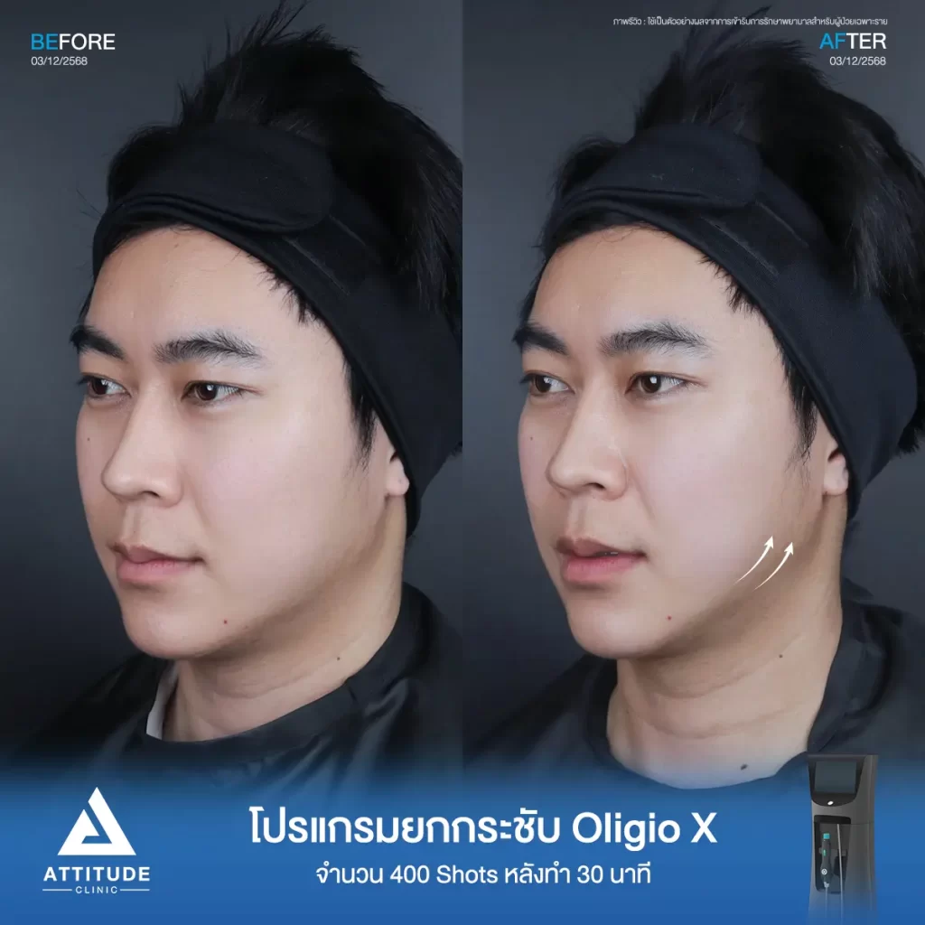 รีวิวโปรแกรมยกกระชับ Oligio X ของพี่โคม จำนวน 400 shot หลังทำ 30 นาที ยกกระชับผิว เก็บกรอบหน้าที่ ATTITUDE CLINIC