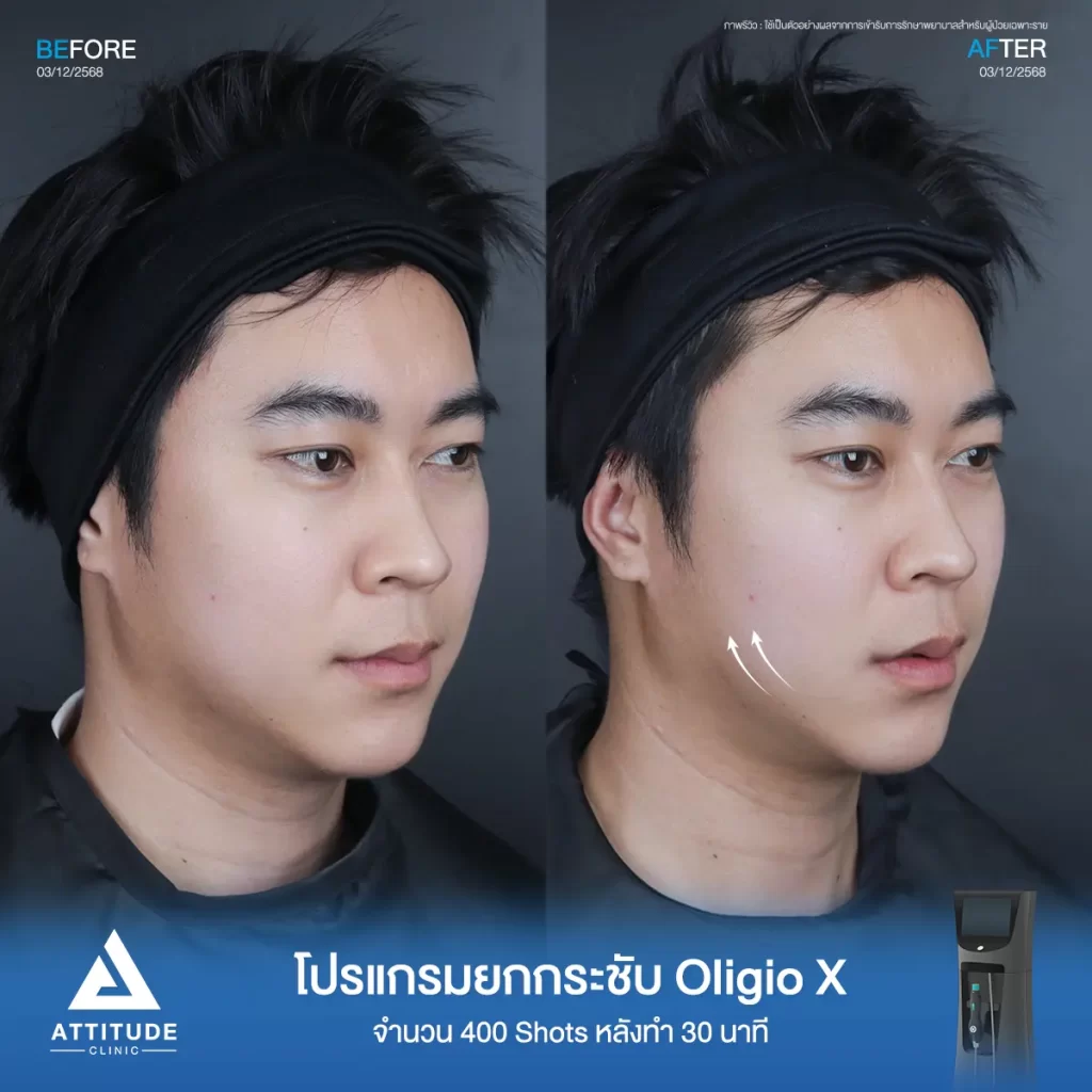 รีวิวโปรแกรมยกกระชับ Oligio X ของพี่โคม จำนวน 400 shot หลังทำ 30 นาที ยกกระชับผิว เก็บกรอบหน้าที่ ATTITUDE CLINIC