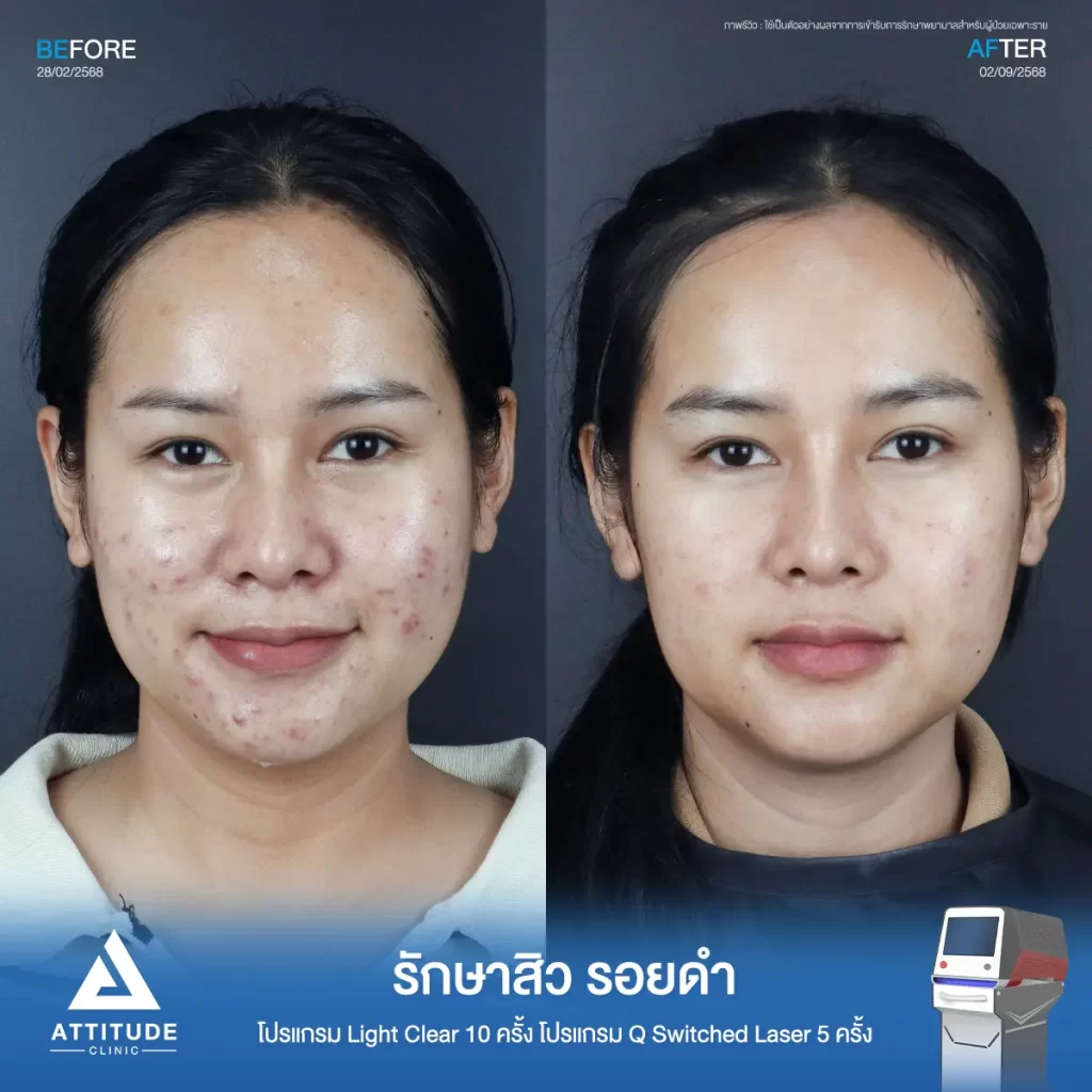 รีวิวรักษาสิวพี่พลอย โปรแกรม Light Clear รักษาสิวด้วยการฉายแสง จำนวน 10 ครั้ง ต่อด้วยโปรแกรม Q Switched Laser รักษารอยดำ รอยสิวจำนวน 5 ครั้งที่ Attitude Clinic