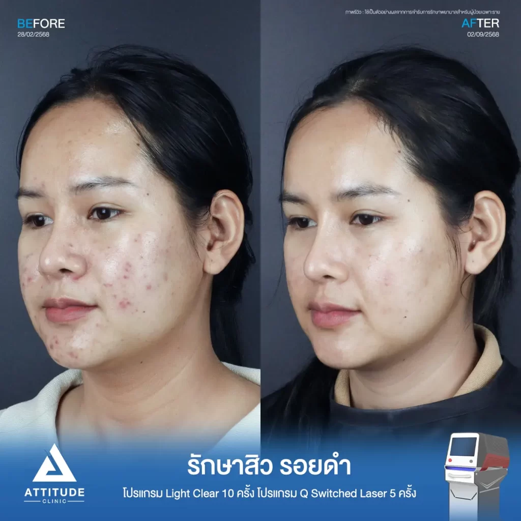 รีวิวรักษาสิวพี่พลอย โปรแกรม Light Clear รักษาสิวด้วยการฉายแสง จำนวน 10 ครั้ง ต่อด้วยโปรแกรม Q Switched Laser รักษารอยดำ รอยสิวจำนวน 5 ครั้งที่ Attitude Clinic