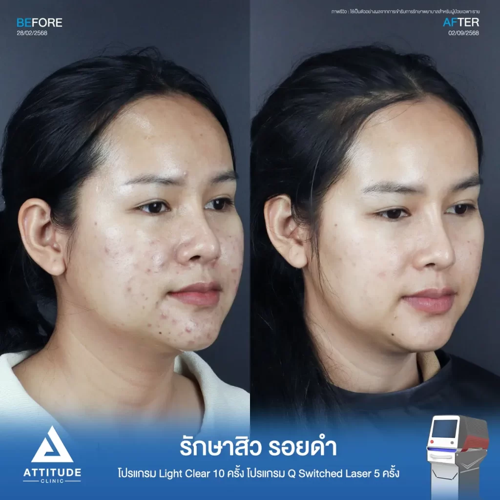 รีวิวรักษาสิวพี่พลอย โปรแกรม Light Clear รักษาสิวด้วยการฉายแสง จำนวน 10 ครั้ง ต่อด้วยโปรแกรม Q Switched Laser รักษารอยดำ รอยสิวจำนวน 5 ครั้งที่ Attitude Clinic