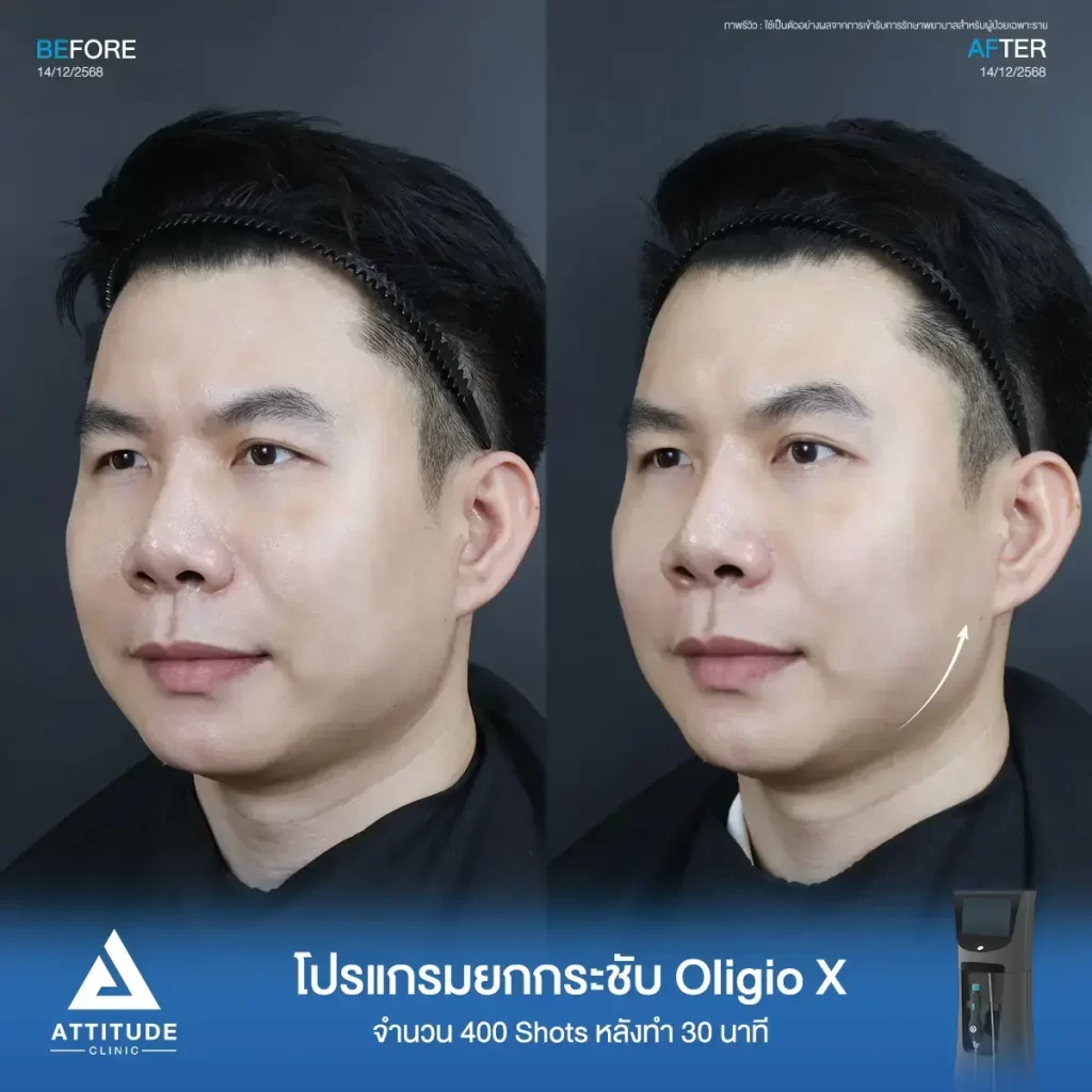 รีวิวโปรแกรมยกกระชับ Oligio X ของพี่ต้อม จำนวน 400 shot หลังทำ 30 นาที แก้ปัญหาผิวหย่อนคล้อยแบบไม่ทำให้ผิวระคายเคืองที่ ATTITUDE CLINIC