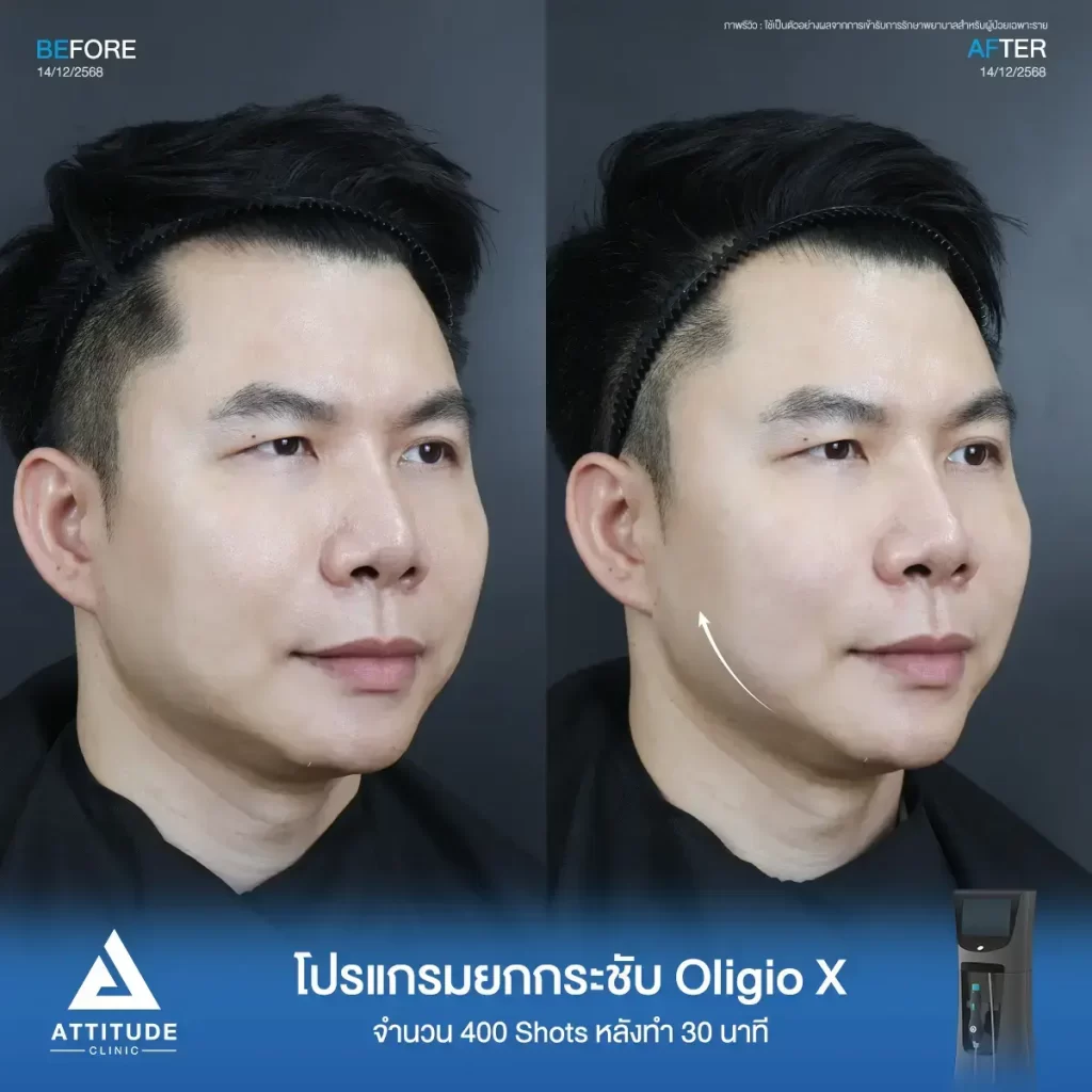 รีวิวโปรแกรมยกกระชับ Oligio X ของพี่ต้อม จำนวน 400 shot หลังทำ 30 นาที แก้ปัญหาผิวหย่อนคล้อยแบบไม่ทำให้ผิวระคายเคืองที่ ATTITUDE CLINIC