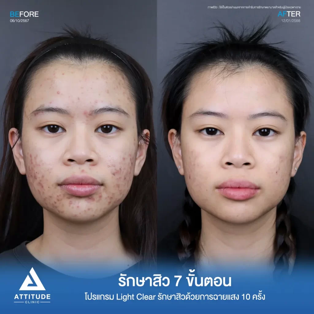 รีวิวรักษาสิวพี่แบม โปรแกรม Light Clear รักษาสิวด้วยการฉายแสง จำนวน 10 ครั้งที่ Attitude Clinic