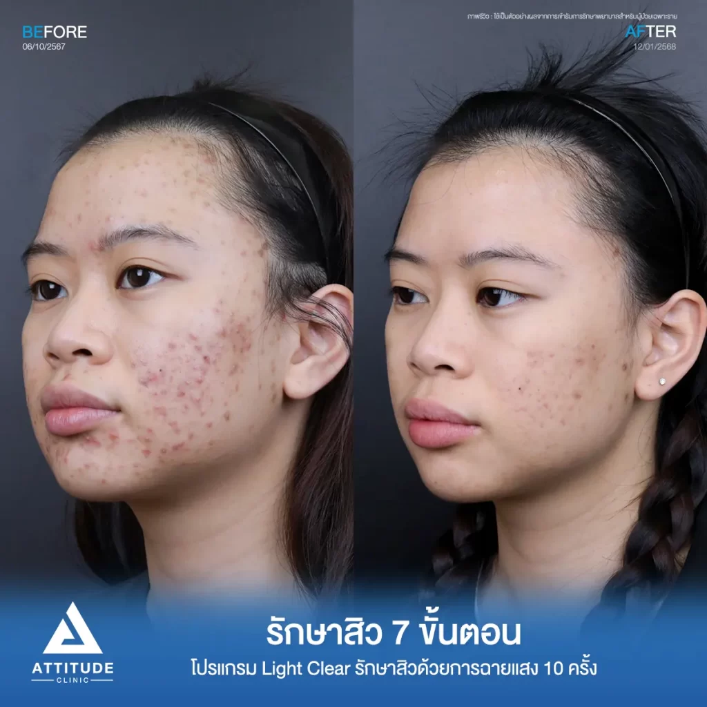 รีวิวรักษาสิวพี่แบม โปรแกรม Light Clear รักษาสิวด้วยการฉายแสง จำนวน 10 ครั้งที่ Attitude Clinic