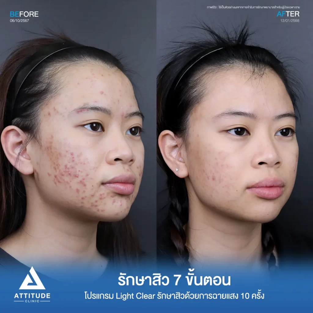 รีวิวรักษาสิวพี่แบม โปรแกรม Light Clear รักษาสิวด้วยการฉายแสง จำนวน 10 ครั้งที่ Attitude Clinic