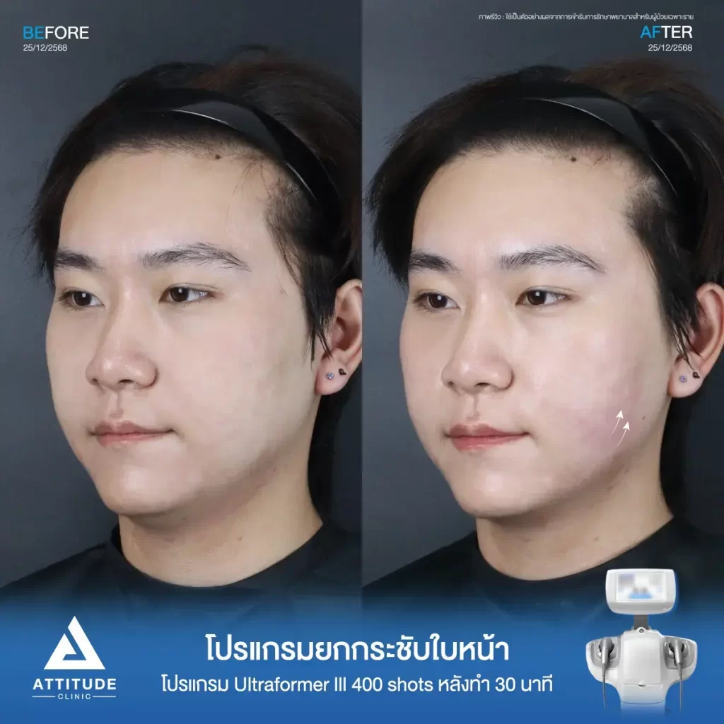 รีวิวโปรแกรมยกกระชับ Ultraformer III ของพี่พีพี จำนวน 400 shot หลังทำ 30 นาที ยกกระชับผิว ลดแก้ม ลดเหนียงที่ ATTITUDE CLINIC
