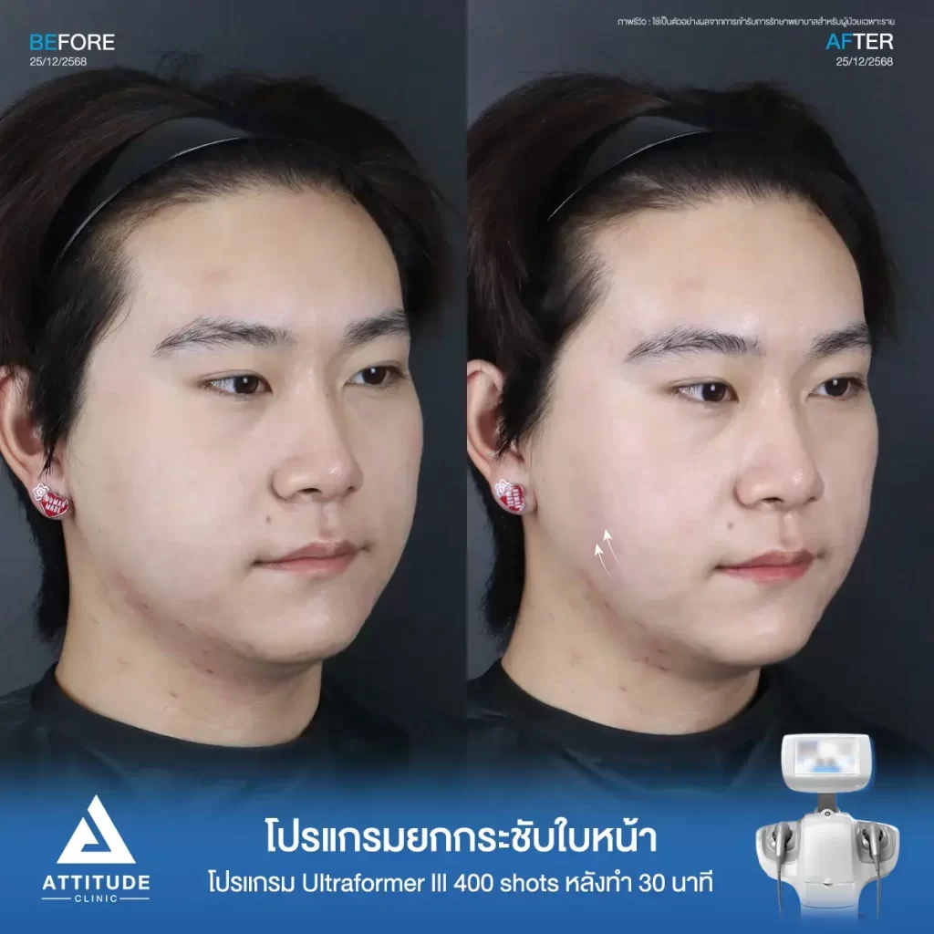 รีวิวโปรแกรมยกกระชับ Ultraformer III ของพี่พีพี จำนวน 400 shot หลังทำ 30 นาที ยกกระชับผิว ลดแก้ม ลดเหนียงที่ ATTITUDE CLINIC