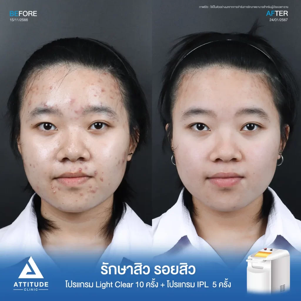 รีวิวรักษาสิวพี่อิง โปรแกรม Light Clear รักษาสิวด้วยการฉายแสง จำนวน 10 ครั้ง ต่อด้วยโปรแกรม IPL รักษารอยสิว จำนวน 5 ครั้งที่ Attitude Clinic