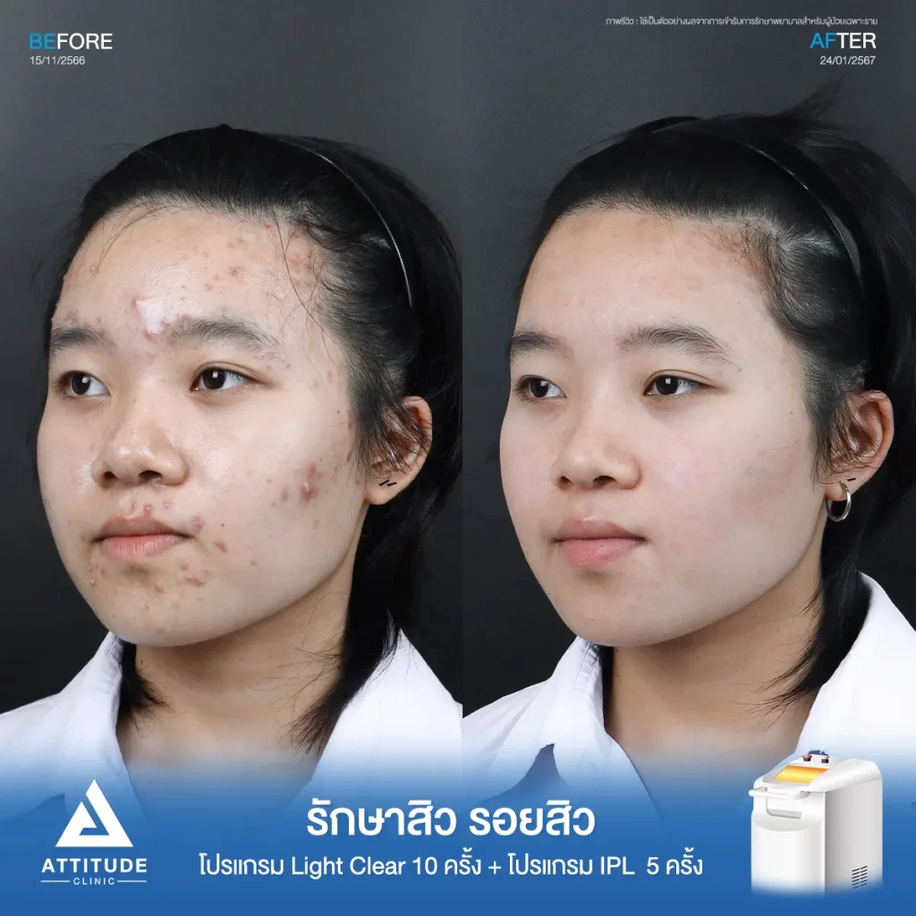 รีวิวรักษาสิวพี่อิง โปรแกรม Light Clear รักษาสิวด้วยการฉายแสง จำนวน 10 ครั้ง ต่อด้วยโปรแกรม IPL รักษารอยสิว จำนวน 5 ครั้งที่ Attitude Clinic