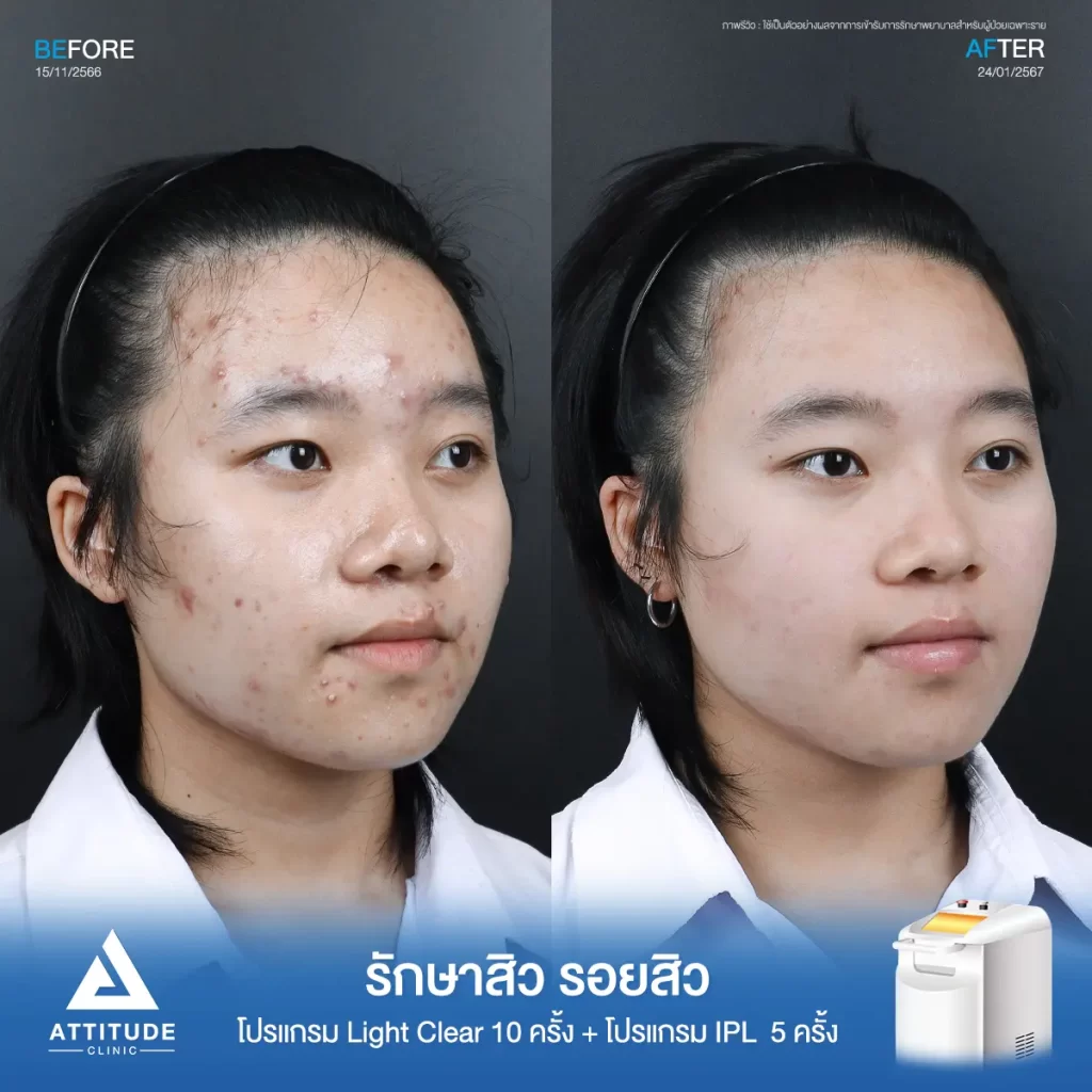 รีวิวรักษาสิวพี่อิง โปรแกรม Light Clear รักษาสิวด้วยการฉายแสง จำนวน 10 ครั้ง ต่อด้วยโปรแกรม IPL รักษารอยสิว จำนวน 5 ครั้งที่ Attitude Clinic