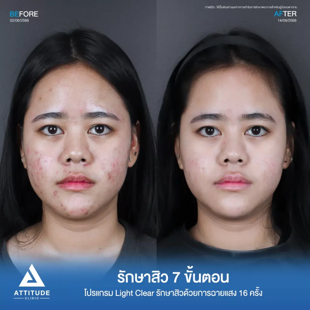 รีวิวรักษาสิวพี่ทาย โปรแกรม Light Clear รักษาสิวด้วยการฉายแสง จำนวน 16 ครั้งที่ Attitude Clinic