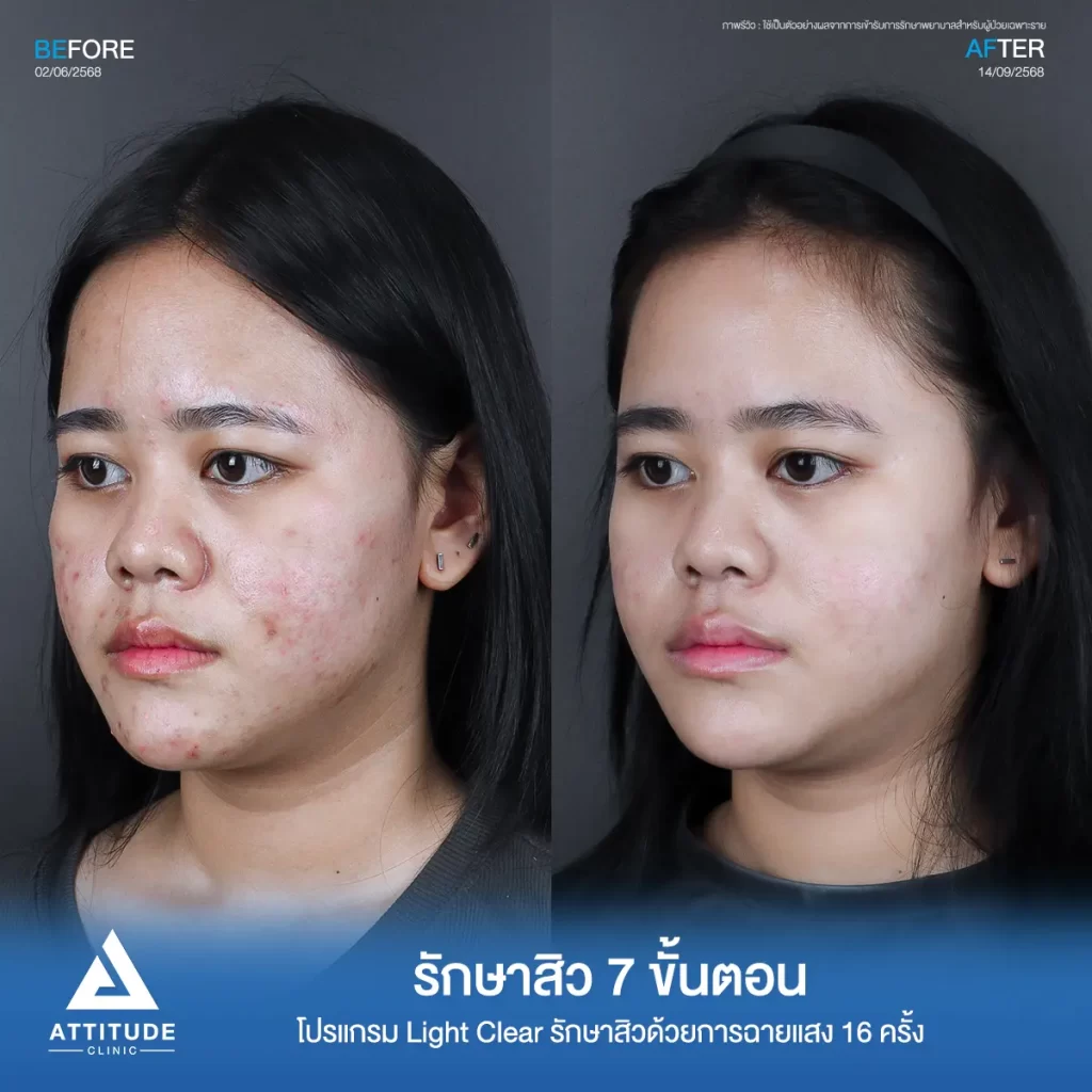 รีวิวรักษาสิวพี่ทาย โปรแกรม Light Clear รักษาสิวด้วยการฉายแสง จำนวน 16 ครั้งที่ Attitude Clinic