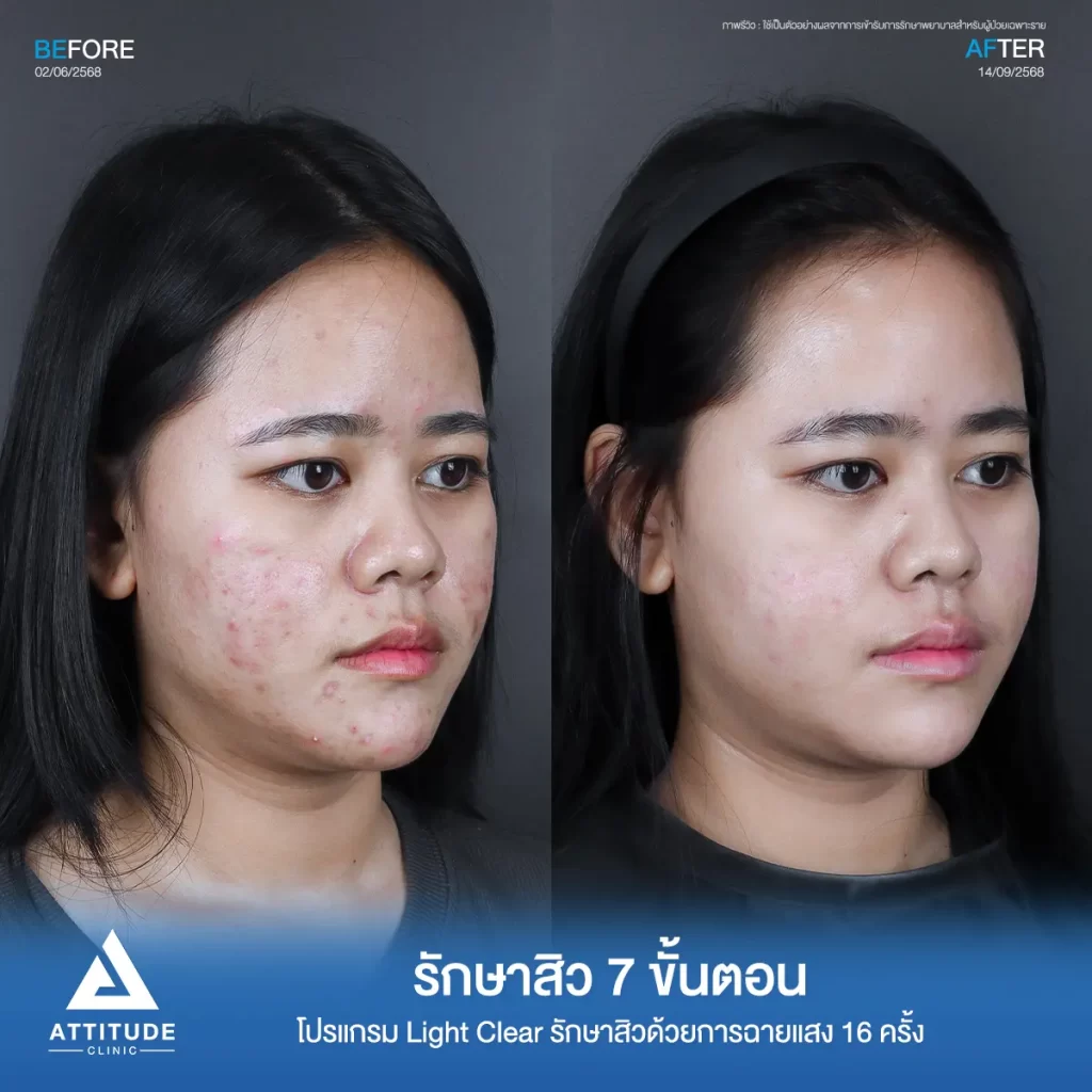 รีวิวรักษาสิวพี่ทาย โปรแกรม Light Clear รักษาสิวด้วยการฉายแสง จำนวน 16 ครั้งที่ Attitude Clinic