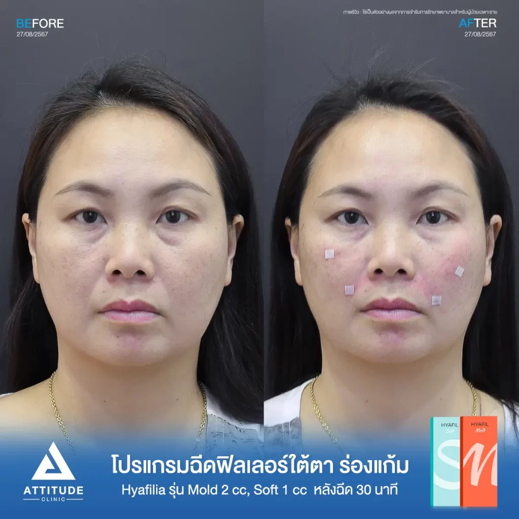 รีวิวโปรแกรมฉีดฟิลเลอร์พี่แอ๋ว เติมเต็มใต้ตา และร่องแก้มด้วย Hya รุ่น S และ M จำนวน 3 cc หลังทำ 30 นาที เติมเต็มร่องลึกใต้ตา และร่องแก้มให้อิ่มฟู เรียบเนียนที่ ATTITUDE CLINIC