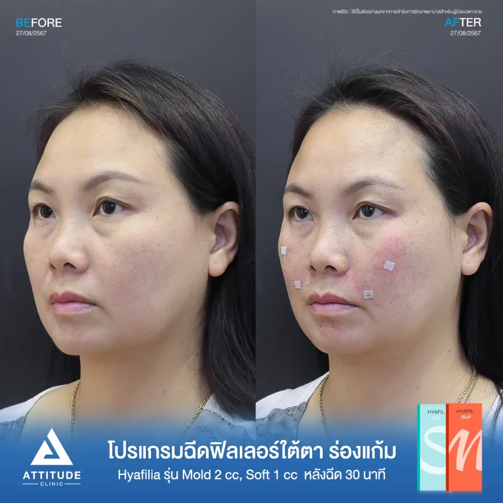 รีวิวโปรแกรมฉีดฟิลเลอร์พี่แอ๋ว เติมเต็มใต้ตา และร่องแก้มด้วย Hya รุ่น S และ M จำนวน 3 cc หลังทำ 30 นาที เติมเต็มร่องลึกใต้ตา และร่องแก้มให้อิ่มฟู เรียบเนียนที่ ATTITUDE CLINIC