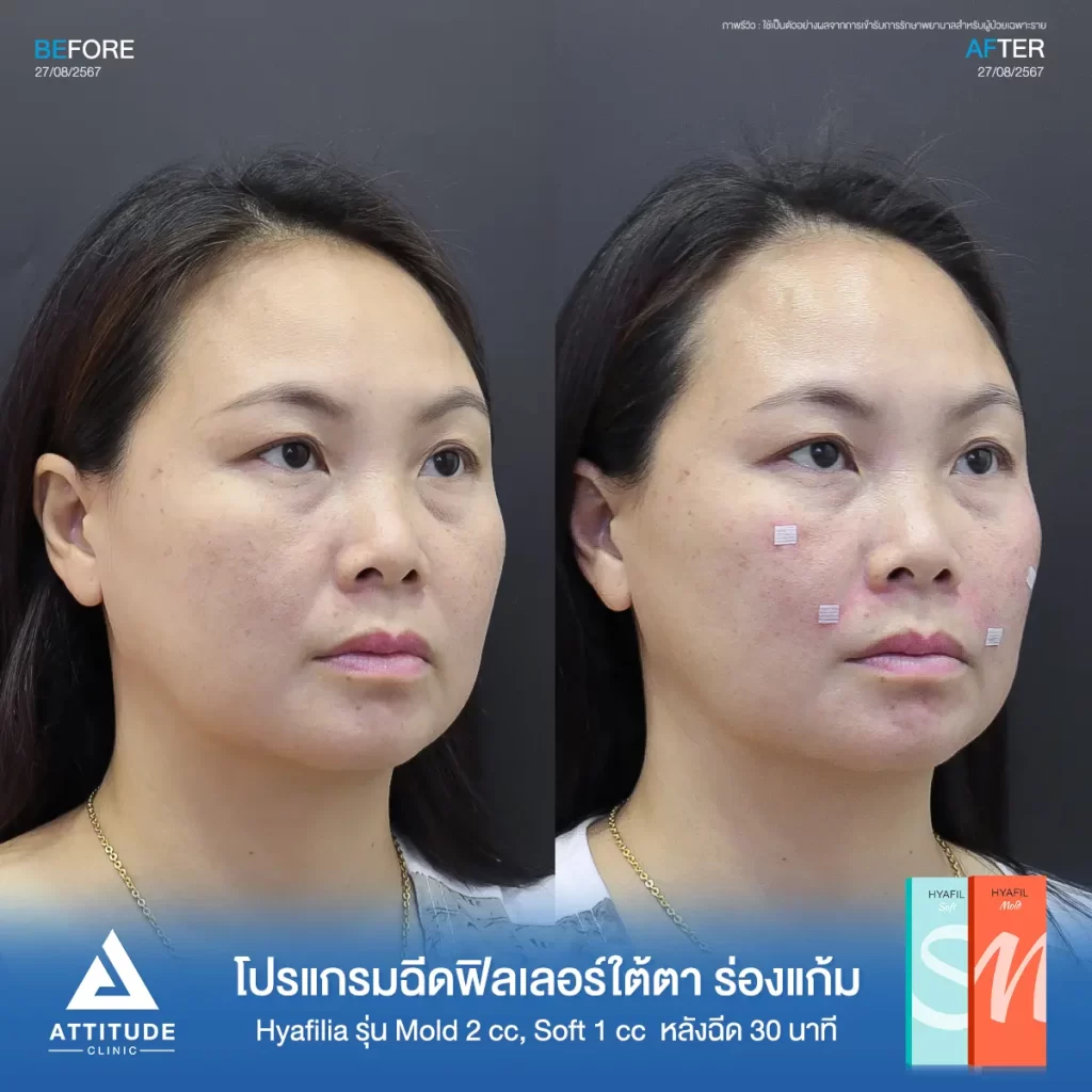 รีวิวโปรแกรมฉีดฟิลเลอร์พี่แอ๋ว เติมเต็มใต้ตา และร่องแก้มด้วย Hya รุ่น S และ M จำนวน 3 cc หลังทำ 30 นาที เติมเต็มร่องลึกใต้ตา และร่องแก้มให้อิ่มฟู เรียบเนียนที่ ATTITUDE CLINIC