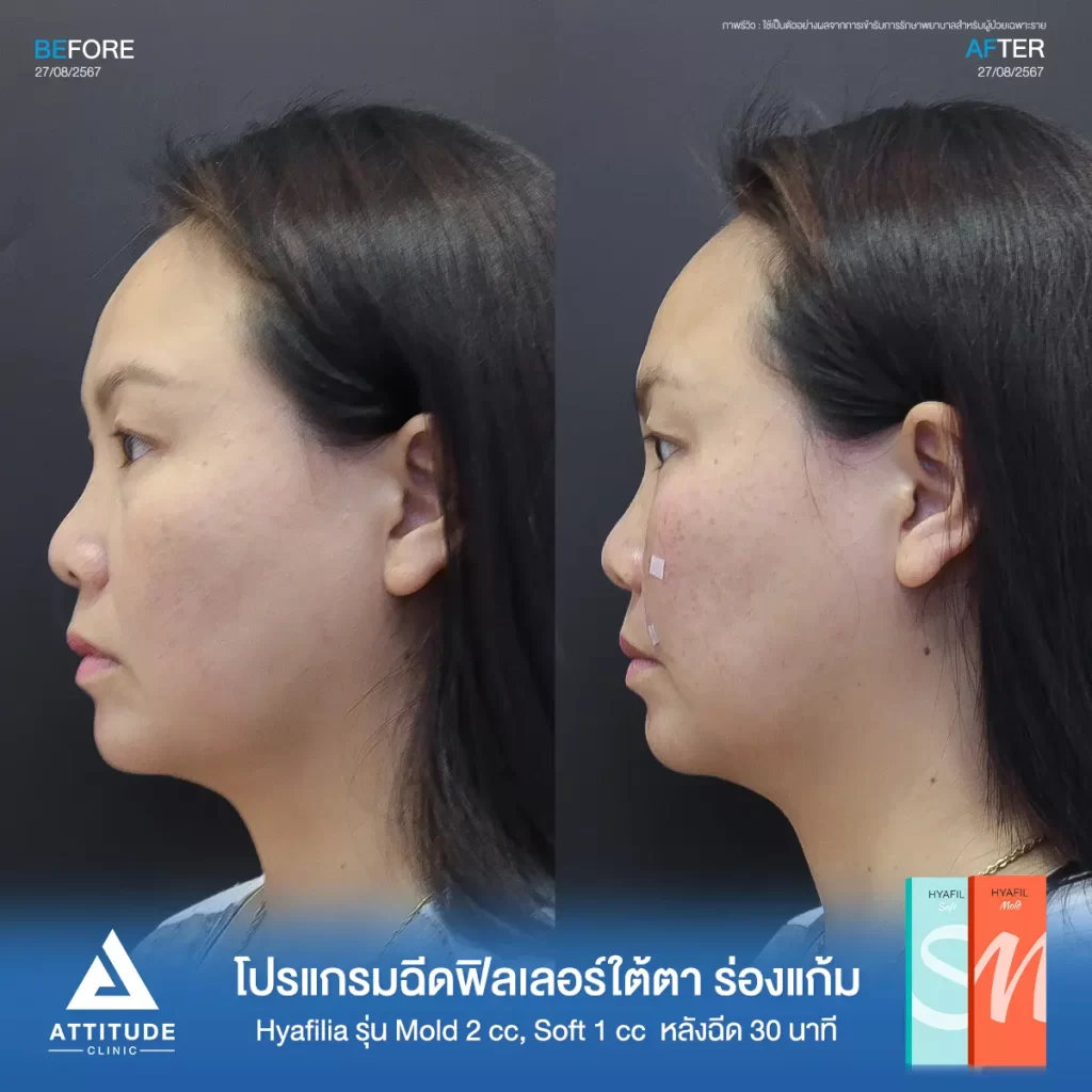 รีวิวโปรแกรมฉีดฟิลเลอร์พี่แอ๋ว เติมเต็มใต้ตา และร่องแก้มด้วย Hya รุ่น S และ M จำนวน 3 cc หลังทำ 30 นาที เติมเต็มร่องลึกใต้ตา และร่องแก้มให้อิ่มฟู เรียบเนียนที่ ATTITUDE CLINIC
