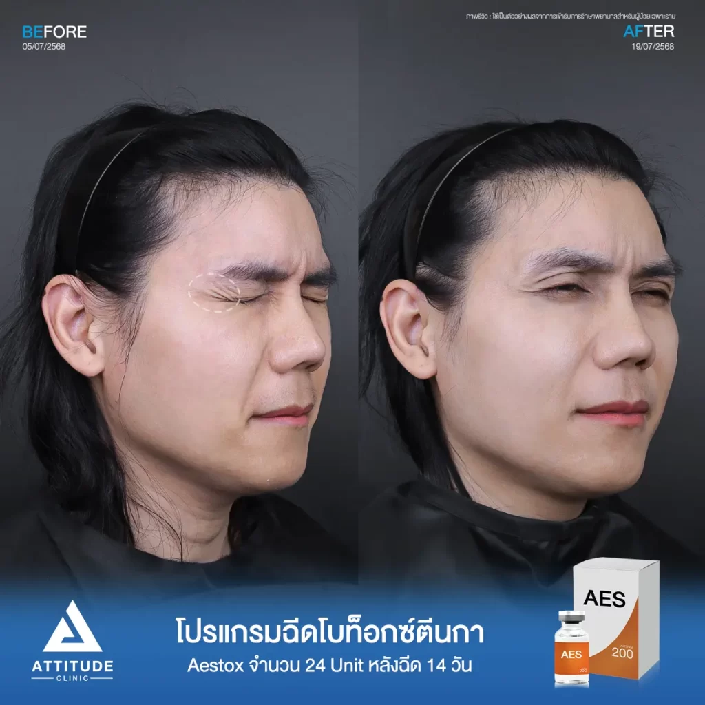 รีวิวโปรแกรมฉีดโบท็อกซ์พี่บอม AES จำนวน 28 ยูนิต หลังทำ 14 วัน จัดการริ้วรอยตีนกา และใต้ตาให้ดูเรียบเนียนขึ้นที่ ATTITUDE CLINIC