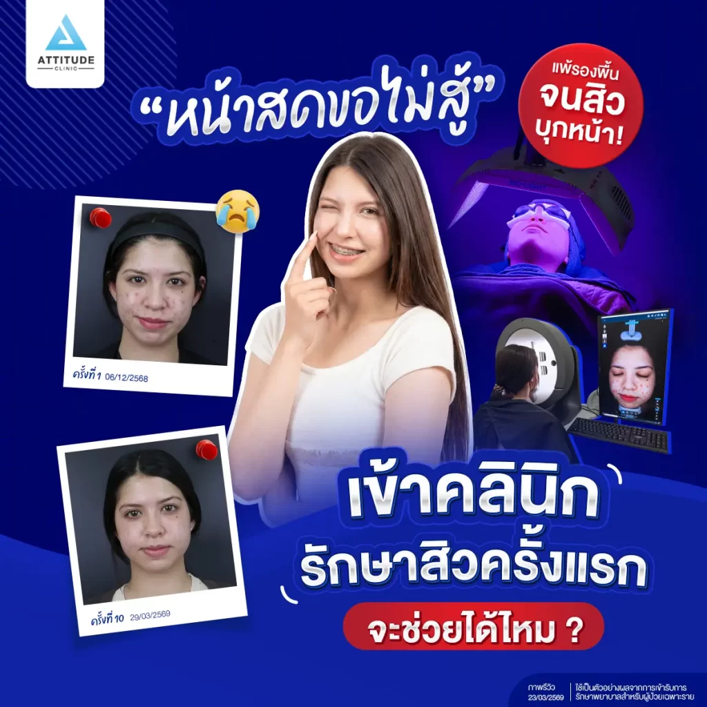 แพ้รองพื้นจนสิวบุกทั่วหน้า! จนไม่กล้าหน้าสดออกจากบ้านเลย 🧐 เปิดใจรักษาสิวที่คลินิกครั้งแรก จะหายไหม?