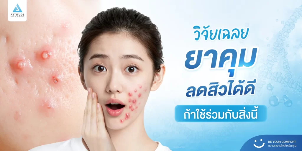 วิจัยเผยยาคุมกำเนิดช่วยลดสิวได้ ถ้าใช้ร่วมกับสิ่งนี้!