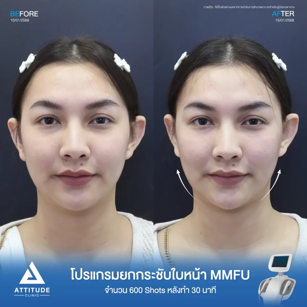 รีวิวโปรแกรมยกกระชับ Ultraformer III ของพี่อุ๋มอิ๋ม จำนวน 600 shot หลังทำ 30 นาที ยกกระชับผิว ลดแก้ม เก็บกรอบหน้าที่ ATTITUDE CLINIC