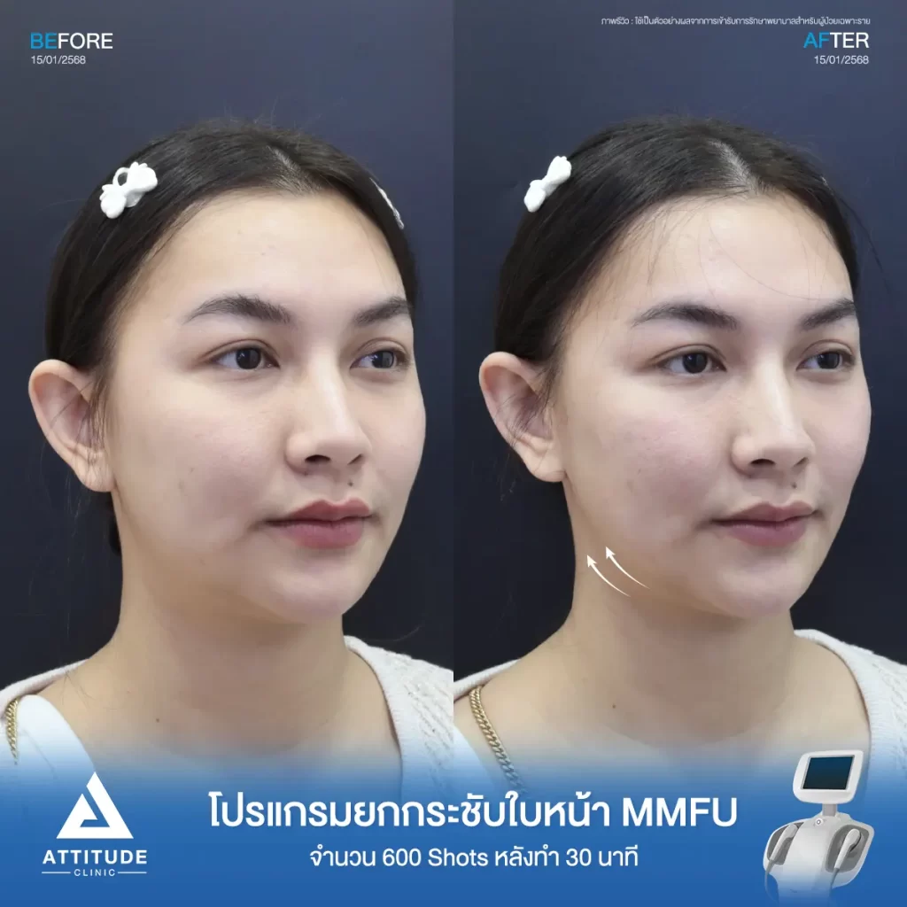 รีวิวโปรแกรมยกกระชับ Ultraformer III ของพี่อุ๋มอิ๋ม จำนวน 600 shot หลังทำ 30 นาที ยกกระชับผิว ลดแก้ม เก็บกรอบหน้าที่ ATTITUDE CLINIC
