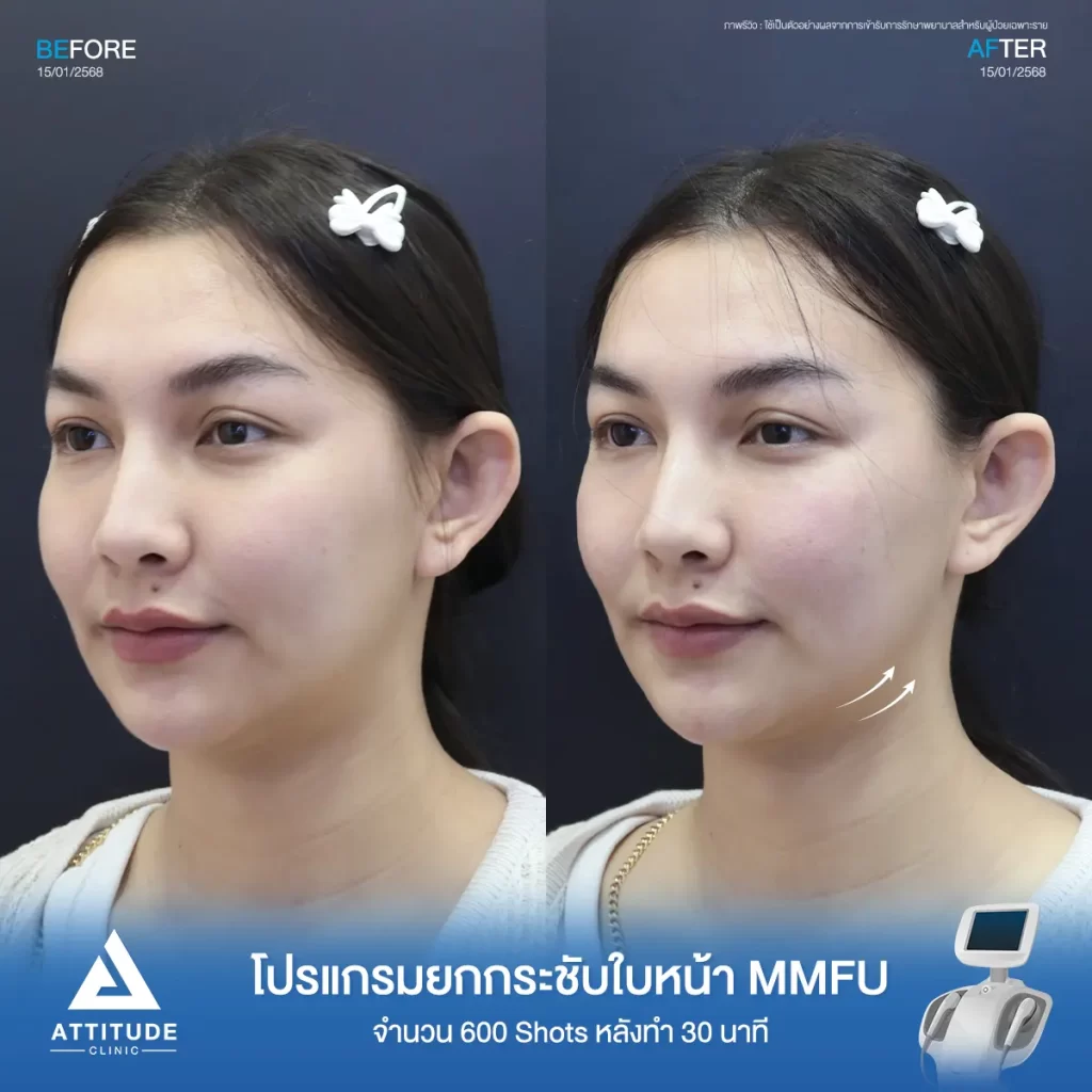 รีวิวโปรแกรมยกกระชับ Ultraformer III ของพี่อุ๋มอิ๋ม จำนวน 600 shot หลังทำ 30 นาที ยกกระชับผิว ลดแก้ม เก็บกรอบหน้าที่ ATTITUDE CLINIC